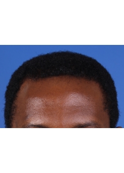 After Hair Transplant&nbsp;Front